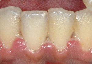 Placa bacteriana