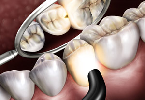 Caria dentara