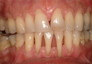 Tartrul dentar