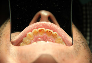 Eroziunile dentare cauzate de alimente acide