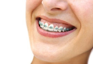 Igiena orala la purtatorii de aparate dentare ortodontice